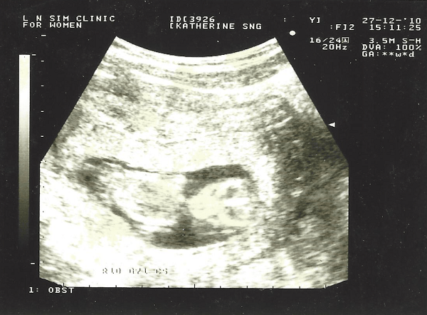 flying solo baby scan