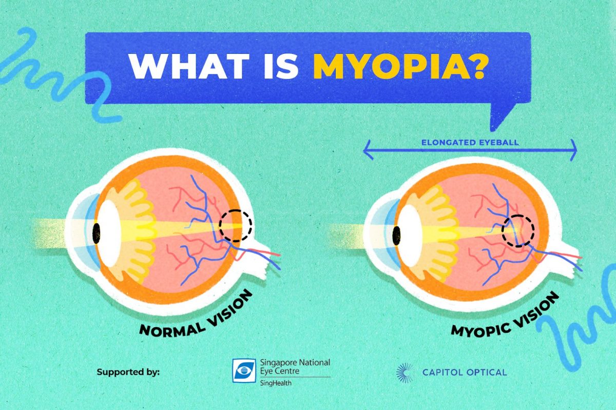 infographic explaining what is myopia